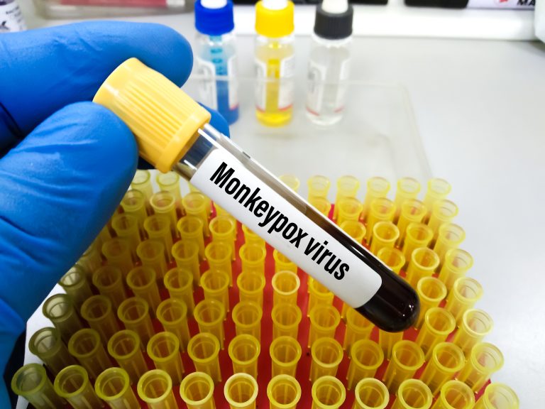 Monkeypox,Infection,Pandemic.,Monkeypox,Infected,Blood,Sample,At,Doctor's,Hand