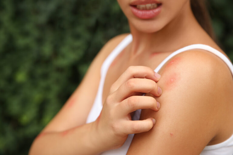 Woman,Scratching,Shoulder,With,Insect,Bite,Outdoors,,Closeup