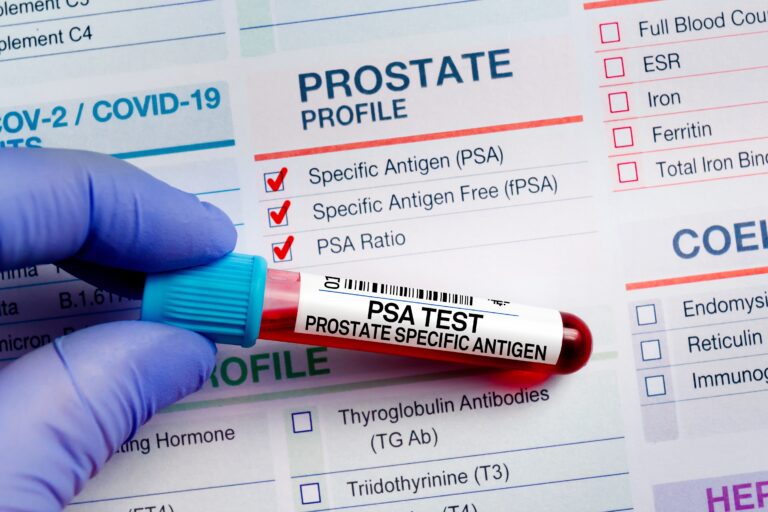 Blood,Sample,Tube,For,Analysis,Of,Psa,Prostate,Specific,Antigen